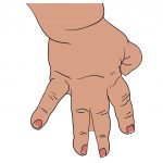 Abnormal shape of hand